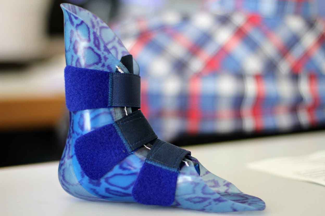 FDM 3D Printed Foot Prosthetic